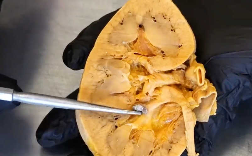 宵夜对肾脏的致命打击:不要再深夜吃饭了! - php中文网